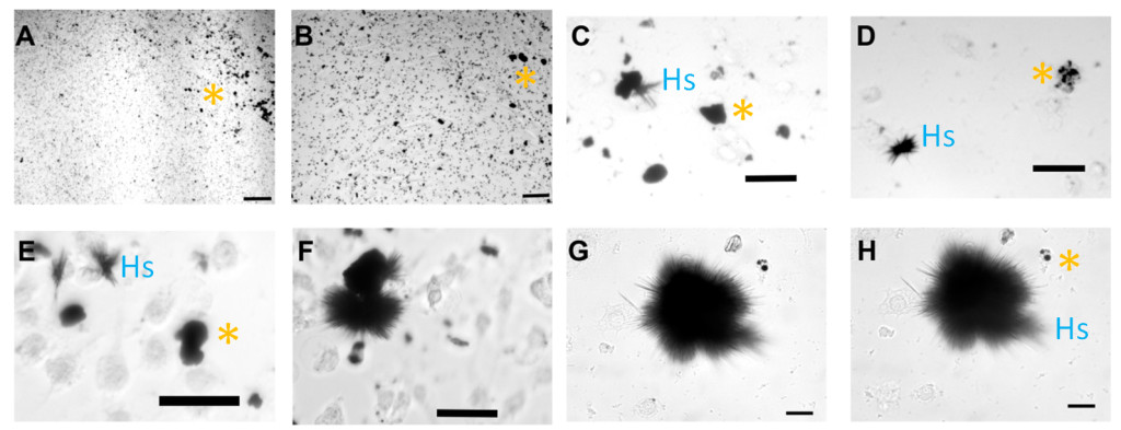 图1。转换的铜纳米颗粒(坎昆Ps) to high-aspect ratio structures (HARs) under biological conditions. CuNPs were interacted with brain tumor cells continuously as shown from time 0 (A+B), and then 17, 24, 36, 49, 69, and 82 hours under biological conditions (body temperature and physiological pH) in panels C-H, respectively. CuNPs (A&B) transformed over time into aggregates (C&D), which increasingly show linear spines (E&F), much like a sea urchin (G&H). The “*” symbols indicates clumped CuNPs, and “Hs” indicates example HARS. Scale bars are indicated in the bottom right of each figure and =100 microns for A+B, 50 microns for C-E, and 25 microns for F+G. (Adapted from the original publication by Cotton Kelly et al. in JOVE 2015).