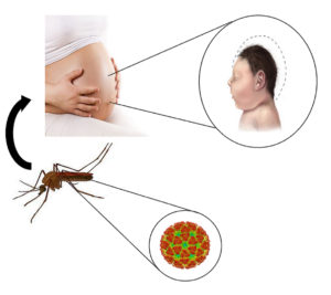 图2所示。寨卡病毒可以从孕妇传染给未出生的孩子。