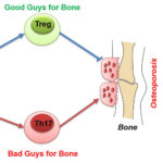 高盐摄入通过增强骨致死性Th17细胞和抑制骨保护性Treg细胞诱导骨质流失。