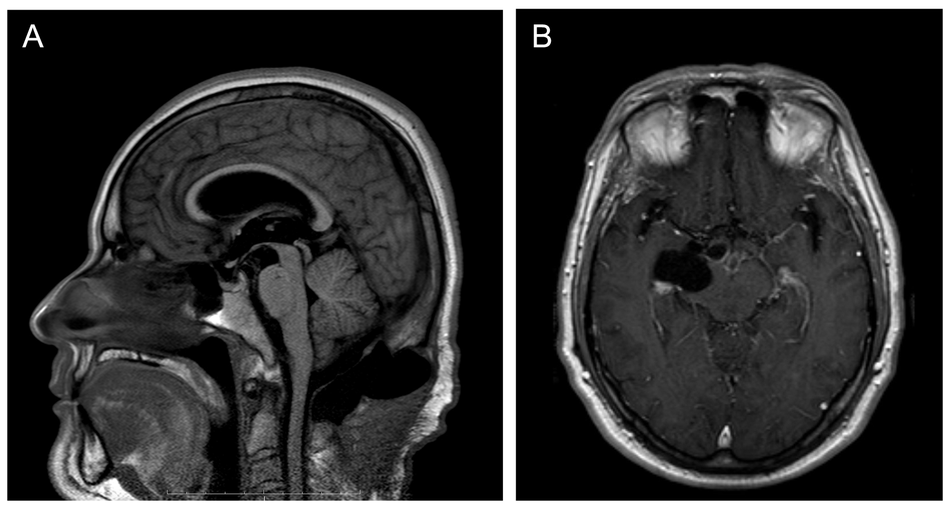 The development of hydrocephalus with reaccumulation of fluid in the surgical site