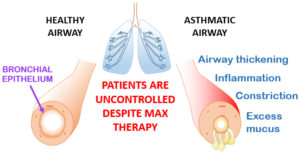 健康和哮喘的气道示意图