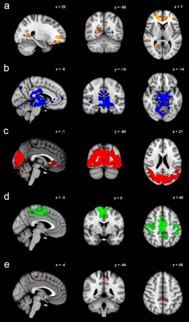 Illustration of sertraline-induced (a) decreases in functional connectivity between orange regions and the default mode network; (b) decreases in functional connectivity between blue regions and the executive control network; (c) decreases in functional connectivity between red regions and the visual networks; (d) decreases in functional connectivity between green regions and the sensorimotor network; (e) increases in functional connectivity between pink regions and the auditory network.