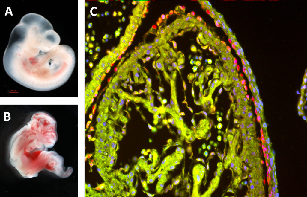 Maternal diabetes may affect the developing embryos and trigger diabetic embryopathy. The external appearances of embryos from non-diabetic pregnancies (A) and embryos with diabetic embryopathy (B) are compared. (C) The section of the diabetes-exposed embryonic heart shows an increased expression of vascular endothelial growth factor α (VEGF-A, light green). Epicardial marker, Wilm‘s tumour gene 1 (red), and nuclei (blue).are shown. Increased VEGF-A may alter morphogenic processes in the heart resulting in diabetic embryopathy.
