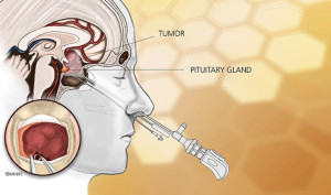 图1所示。©太平洋脑肿瘤中心:鼻内窥镜手术
