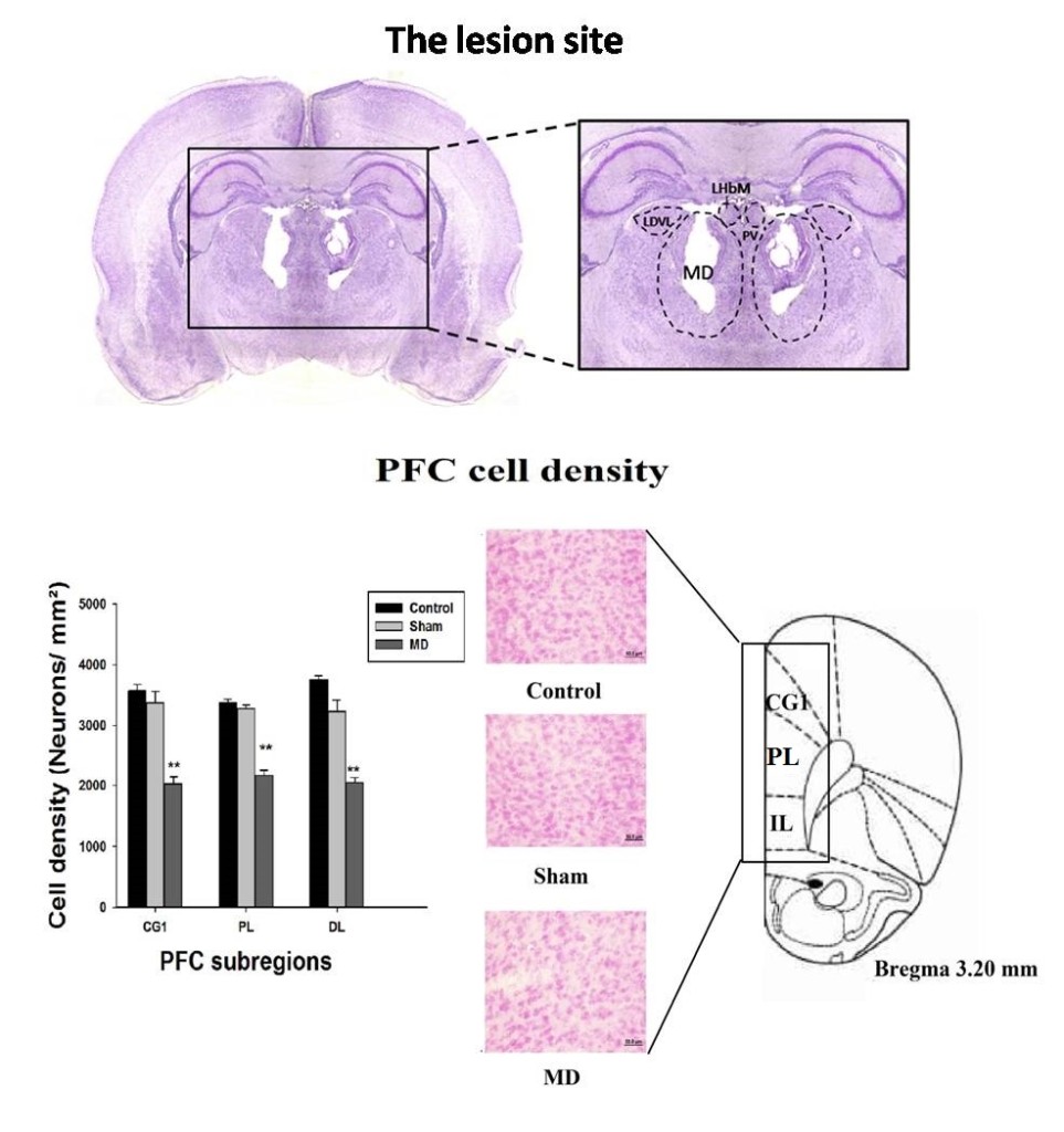 图1所示。成年大鼠出生后第4天产生的丘脑中背侧(MD)病变损伤的显微照片(上图)。在出生后第4天，大鼠遭受选择性神经元损伤后，评估前额叶皮层(PFC)选择性区域锥体细胞密度变化(神经元/平方毫米)，** p值< 0.01(下图左)。大鼠大脑内侧PFC的选择部分的示意图(底部，右)和相应的内侧PFC冠状切片，用于评估我们的对照组(仅麻醉)，假手术(仅麻醉和插入热探针)和MD(麻醉，插入热探针并通过电流)大鼠内侧PFC内的细胞密度。缩写:CG1 =扣带区1皮层;DL =背外侧前额叶皮层(示意图中未显示)，IL =边缘下皮层，PL =边缘前皮层。