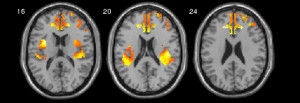 Fig.1. Response of the anterior cingulate cortex and the amygdala to negative emotional stimuli.