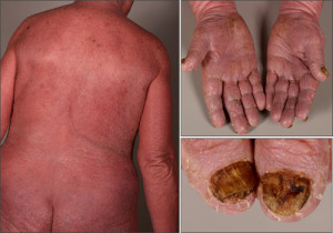 图1所示。ssamzary综合征的临床表现:累及手和指甲的红皮病。