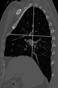 Fig. 2. Lungs without hyperinflation in a patient without COPD