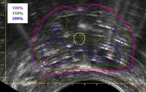 Fig. 1. a transverse image of the prostate on ultrasound during implantation is depicted with the dose distribution in several colours (purple, green and blue). You are looking at a slice of the prostate from below, as if the patient is lying with his legs towards you. The prostate is the red contour, the urethra the yellow and the rectum the brown contour. You can see that the 100% dose line is crossing the rectum.