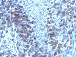 图2所示。sox2阳性细胞聚集在有边界的坏死细胞周围。X 400。