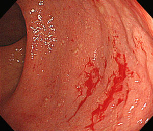 图1所示。大肠(直肠)弥漫性炎症。少量的血液也被观察到。