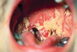 Thrush, a kind of fungal infection in the mouth. Image from Public Health Image Library, www.cdc.gov.