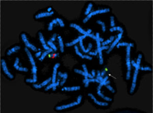 图1所示。一条带有绿色标记的染色体扩散，这条染色体是22号染色体的两个副本。一条染色体正常，包含红色的22q11关键区域;另一条染色体异常(箭头)，缺少关键的红色区域。
