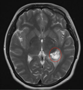 Magnetic resonance scan of the patient’s brain showing cystic lesion (encircled).