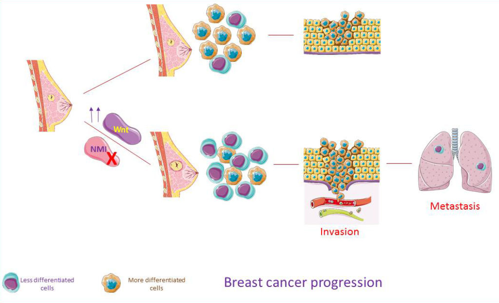 NMI在癌症进展过程中的作用示意图:NMI丢失后，BC中分化程度较低的细胞比例较高