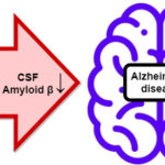 Repetitive DNA in the ABCA7 gene influences Alzheimer’s disease