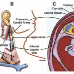 Vagal Stimulation for Treating Syncope by Cardioneuroablation without Pacemaker Implantation