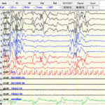 大田原综合征3个月婴儿睡眠时脑电图显示爆发抑制模式。