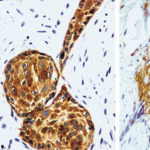 manbetx登录下载科学地图集。皮肤鳞状细胞癌中mtor信号通路蛋白的表达