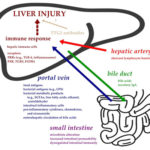 肠肝轴和肝疾病中肝损伤的假定发病机理。AOS
