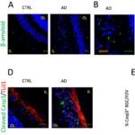 Biomarkers for Alzheimer’s disease diagnosis. AoS