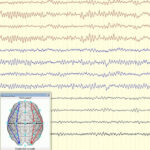 AoS. EEG Reactivity in Coma.