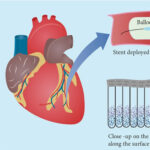 AoS. Ni-free, built-in nanotubular drug eluting stents