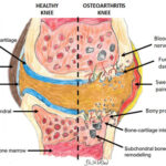 《超能。米esenchymal stem cells for treating knee osteoarthritis