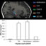 Poverty may affect the developing brain through chronic stress