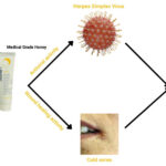 AOS。L-米西兰医学级蜂蜜比常规治疗更好地治疗唇疱疹