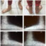 Arthroereisis for symptomatic flexible flatfoot deformity in young children