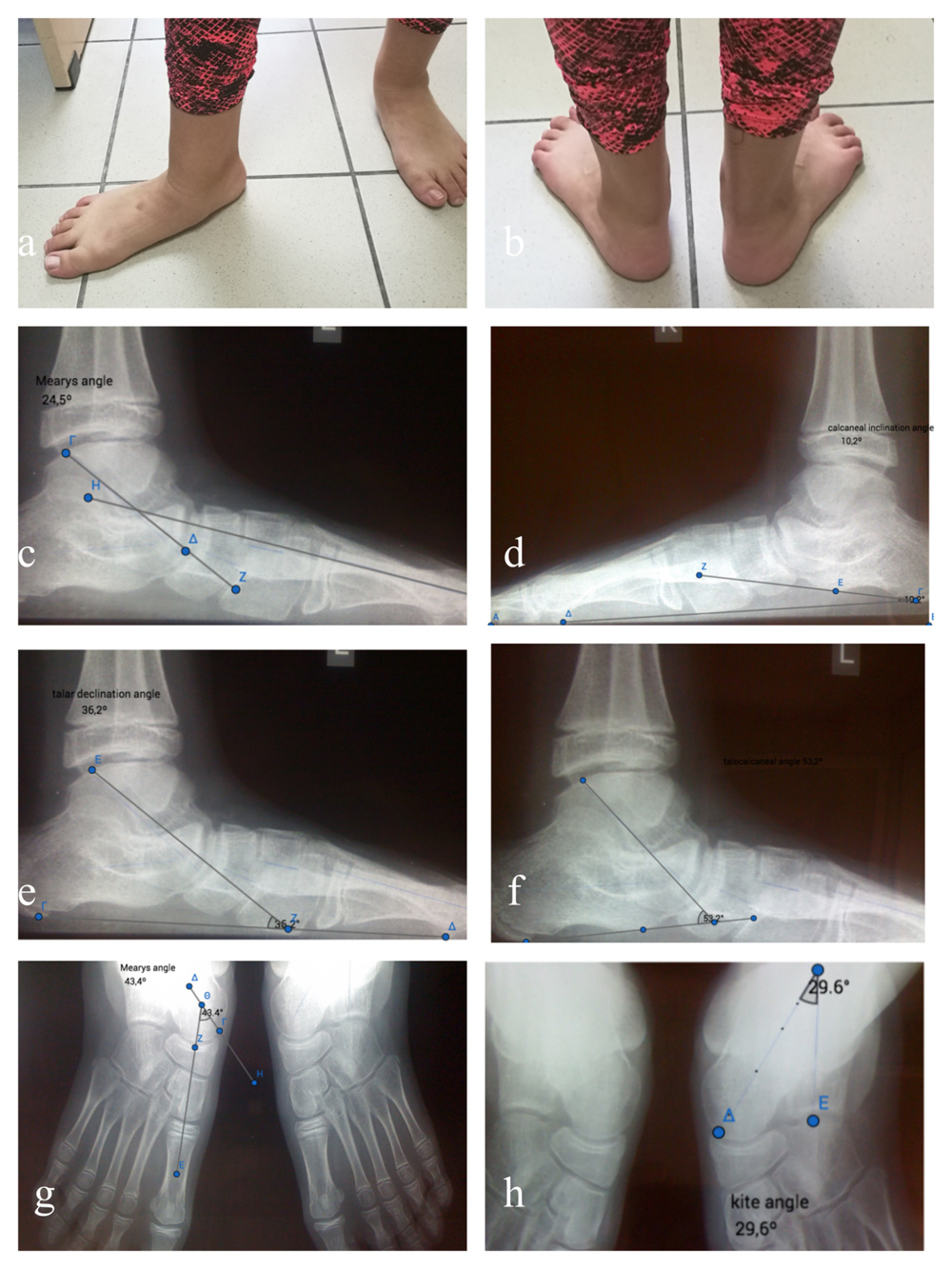 manbetx登录下载科学地图集。幼儿有症状的柔性扁平脚畸形的Arthroereisis
