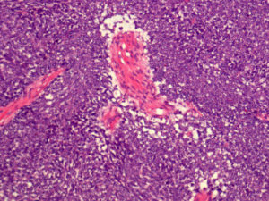 Wilms Tumor and Aneuploidy. Atlas of Science